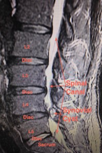 MRI showing synovial cyst in lower back