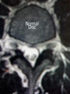 Cross section of normal spinal disc