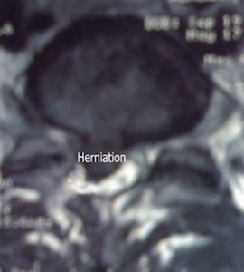 Cross section of vertebra with disc herniation