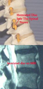 Spinal model vs MRI showing disc bulge