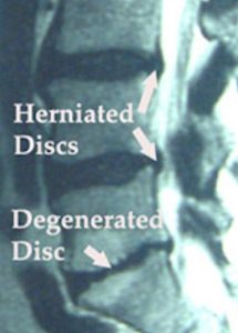 Disc degeneration showing narrowed disc space
