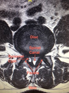 Cross-section MRI of lumbar spine showing synovial cyst