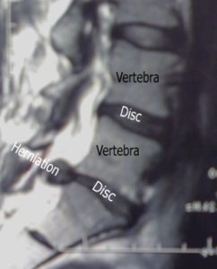 MRI showing large disc herniation side view