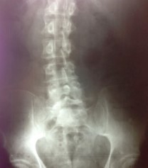 Illustration of scoliosis