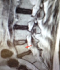 Illustration of spondylolisthesis